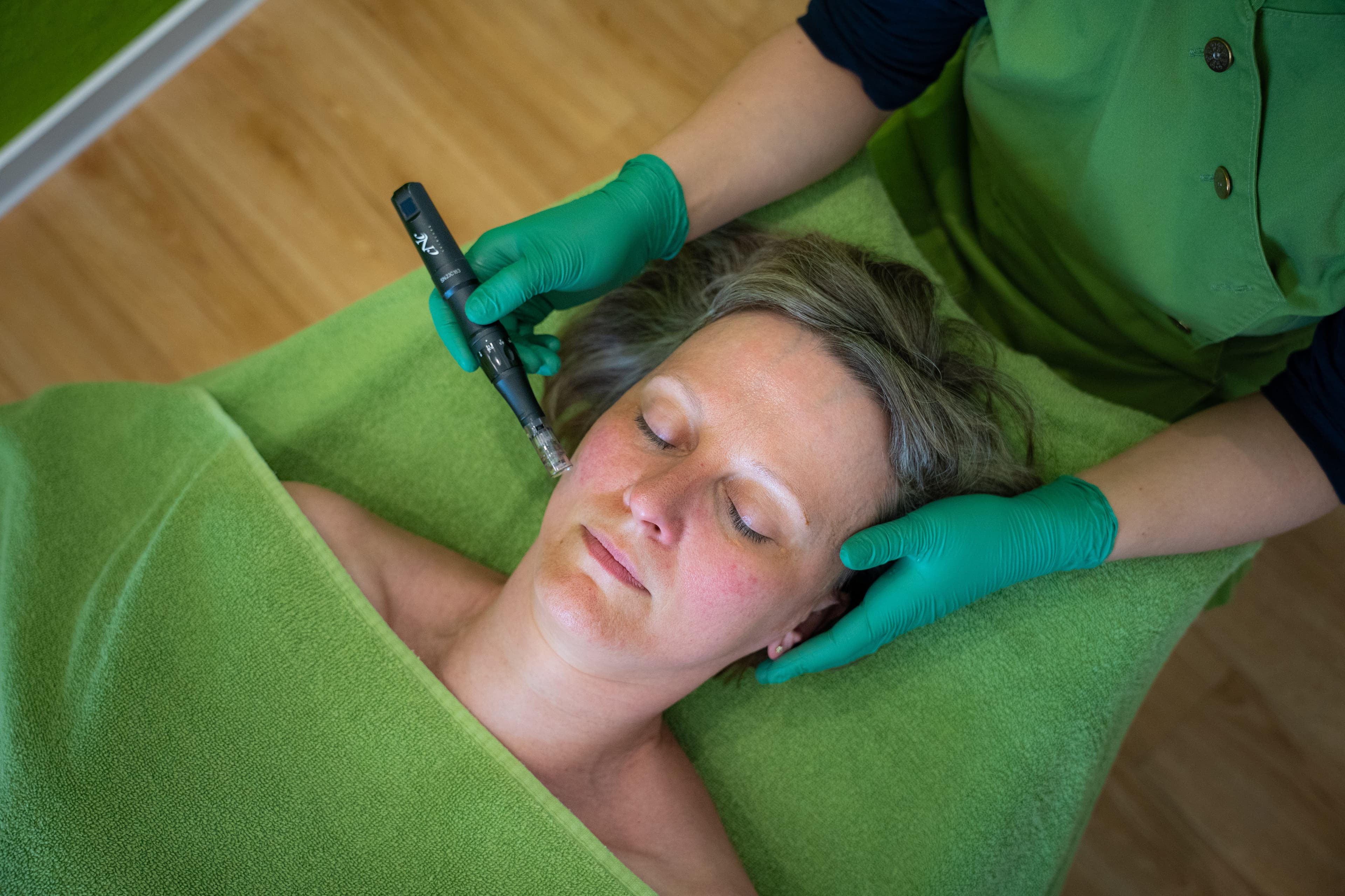 Microneedling-Behandlung fürs Gesicht